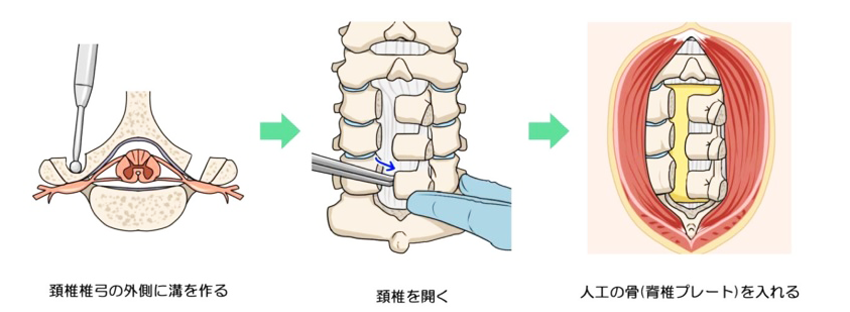 術式 椎弓形成術