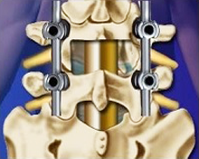 後方椎体固定術